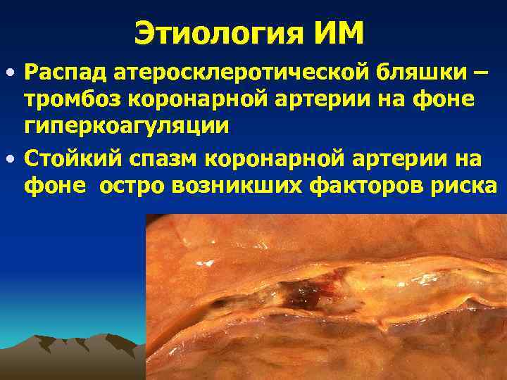    Этиология ИМ • Распад атеросклеротической бляшки –  тромбоз коронарной артерии