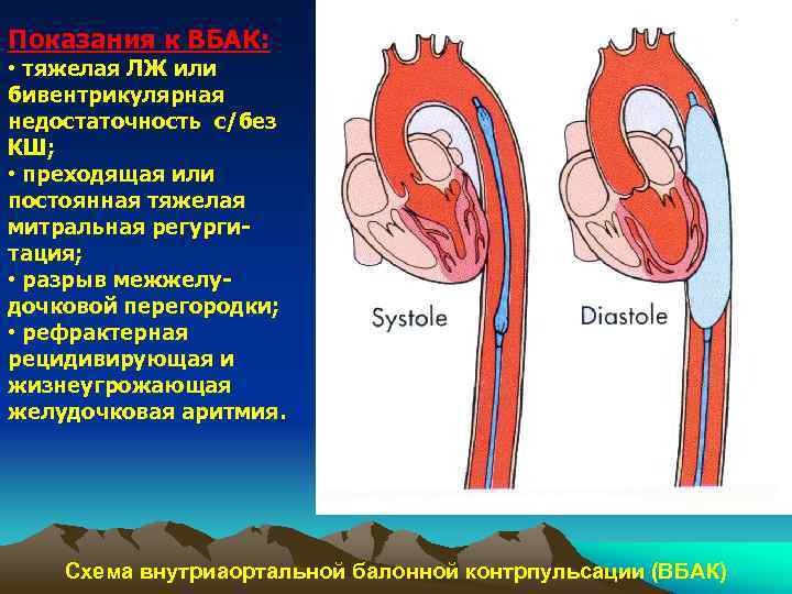 Показания к ВБАК:  • тяжелая ЛЖ или бивентрикулярная недостаточность с/без КШ;  •