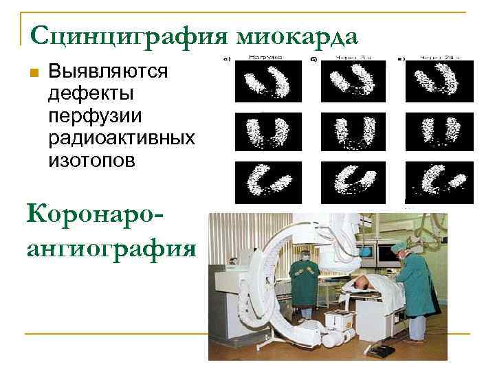 Сцинциграфия миокарда n  Выявляются дефекты перфузии радиоактивных изотопов Коронаро- ангиография 