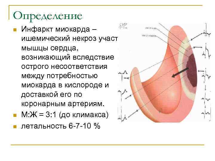 Определение n  Инфаркт миокарда – ишемический некроз участка мышцы сердца, возникающий вследствие острого