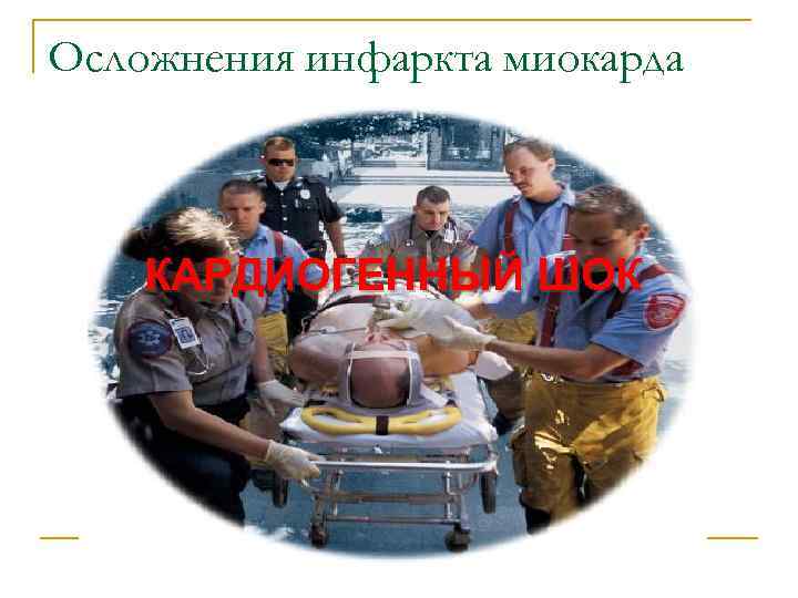 Осложнения инфаркта миокарда  КАРДИОГЕННЫЙ ШОК 