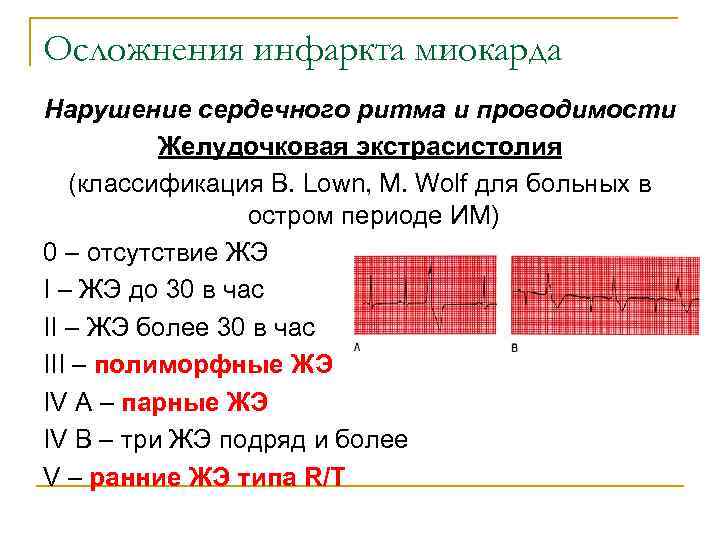 Осложнения инфаркта миокарда Нарушение сердечного ритма и проводимости  Желудочковая экстрасистолия (классификация B. Lown,
