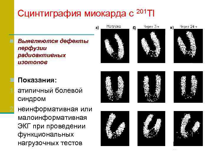 Презентация сцинтиграфия миокарда