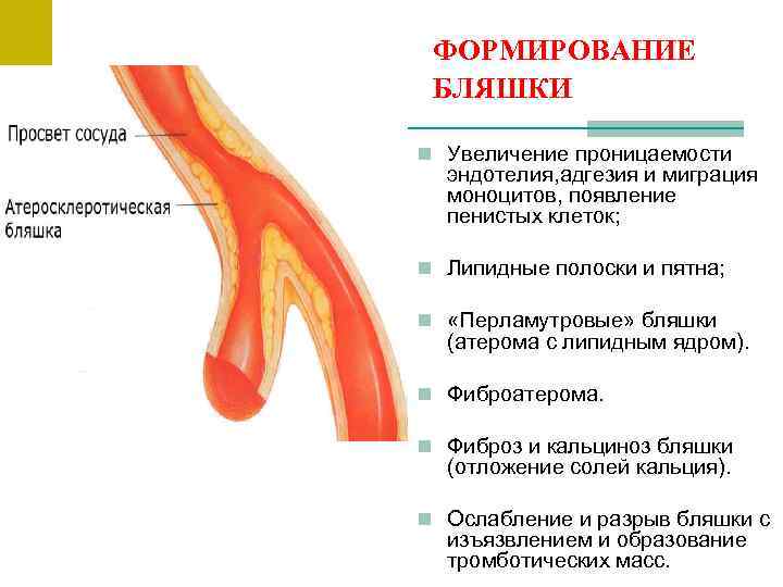  ФОРМИРОВАНИЕ  БЛЯШКИ n Увеличение проницаемости  эндотелия, адгезия и миграция  моноцитов,