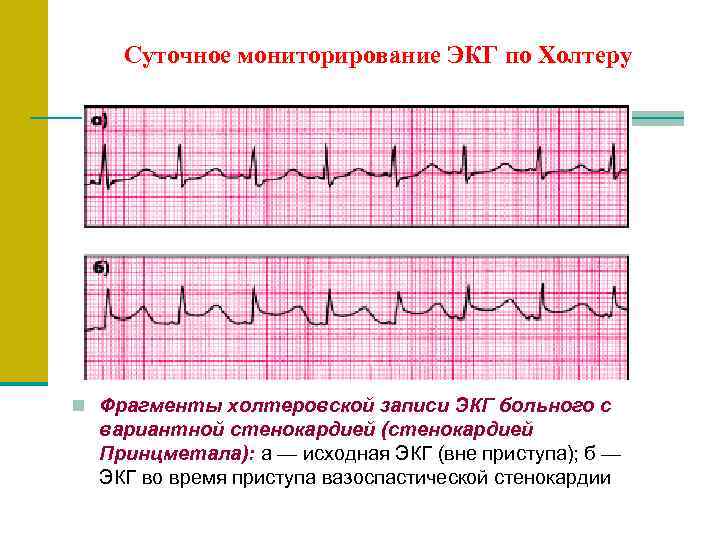   Суточное мониторирование ЭКГ по Холтеру n Фрагменты холтеровской записи ЭКГ больного с