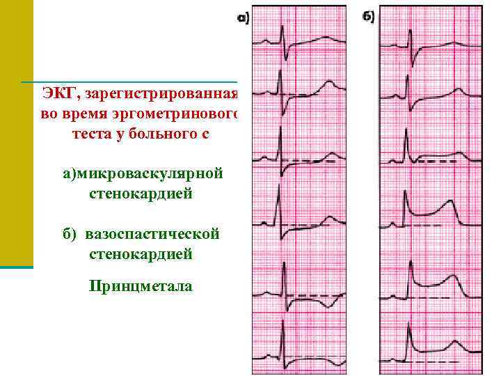 ЭКГ, зарегистрированная во время эргометринового теста у больного с а)микроваскулярной  стенокардией  б)