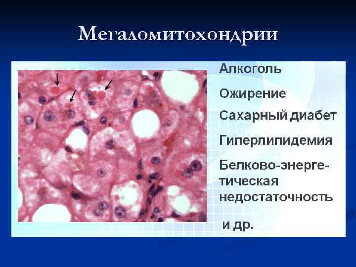 Мегаломитохондрии 