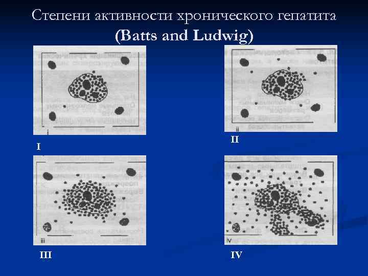 Степени активности хронического гепатита  (Batts and Ludwig)      II