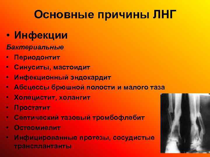  Основные причины ЛНГ • Инфекции Бактериальные • Периодонтит • Синуситы, мастоидит • Инфекционный