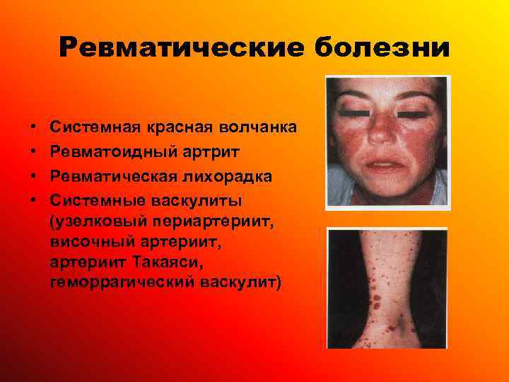   Ревматические болезни  •  Системная красная волчанка •  Ревматоидный артрит