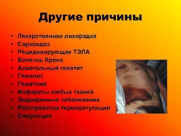    Другие причины •  Лекарственная лихорадка •  Саркоидоз • 