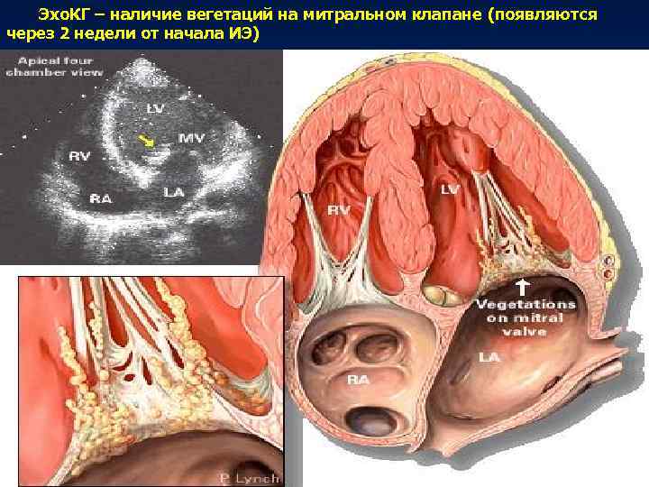 Вегетации на митральном клапане