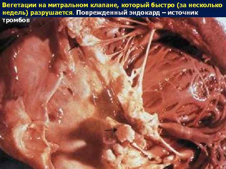 Вегетации на митральном клапане, который быстро (за несколько недель) разрушается. Поврежденный эндокард – источник Вегетации на митральном клапане, который быстро (за несколько недель) разрушается. Поврежденный эндокард – источник