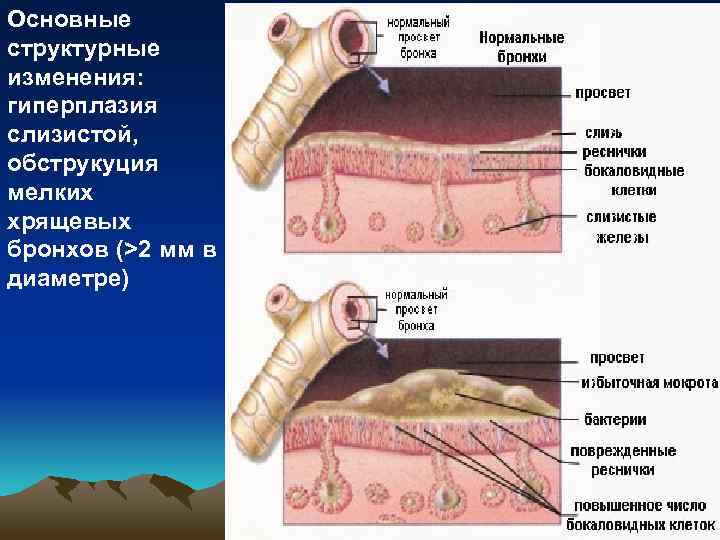 Основные структурные изменения: гиперплазия слизистой, обструкуция мелких хрящевых бронхов (>2 мм в диаметре) 