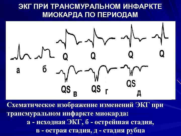 Инфаркт миокарда на экг фото с расшифровкой