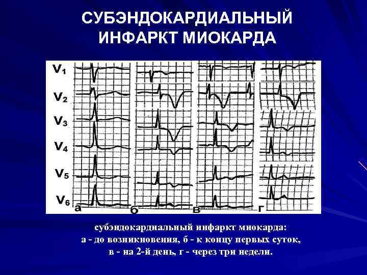 Признаки трансмурального инфаркта. Субэндокардиальная ишемия на ЭКГ. ЭКГ признаки субэндокардиальной ишемии миокарда являются. Инфаркт субэндокардиальный острый ЭКГ. ЭКГ при субэндокардиальная ишемия.