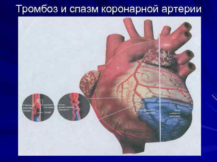 Тромбоз и спазм коронарной артерии 