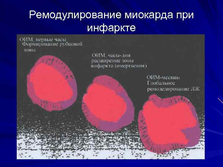 Ремодулирование миокарда при   инфаркте 