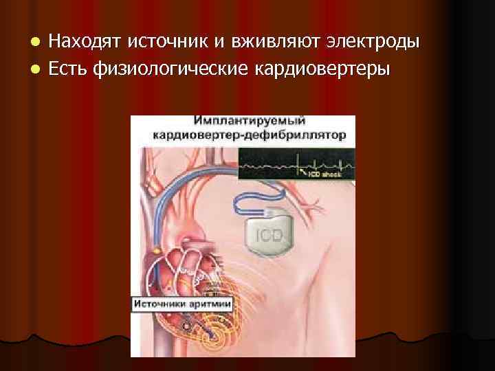 l Находят источник и вживляют электроды l Есть физиологические кардиовертеры 