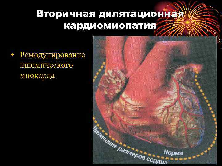  Вторичная дилятационная   кардиомиопатия  • Ремодулирование  ишемического  миокарда 