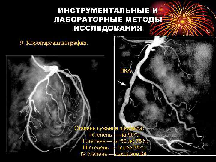  ИНСТРУМЕНТАЛЬНЫЕ И  ЛАБОРАТОРНЫЕ МЕТОДЫ    ИССЛЕДОВАНИЯ 9. Коронароангиография. 