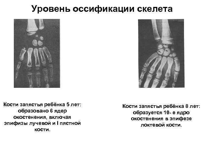    Уровень оссификации скелета Кости запястья ребёнка 5 лет:  Кости запястья
