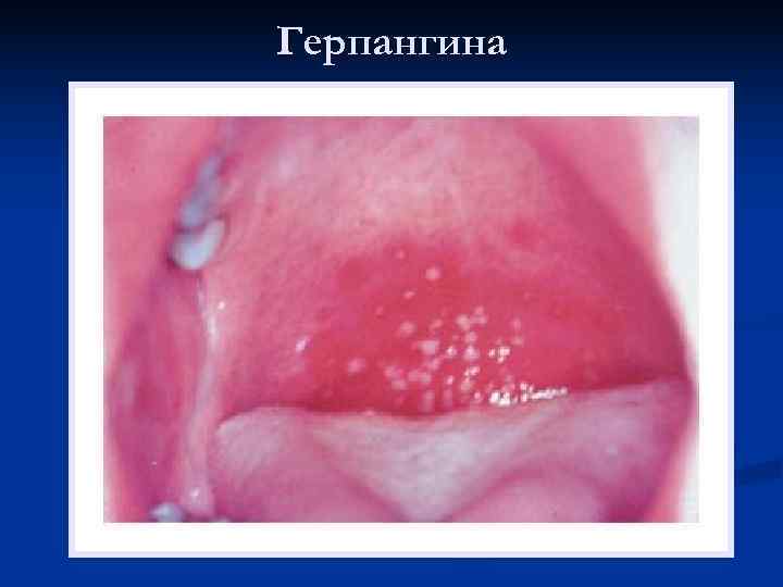 Герпангина 
