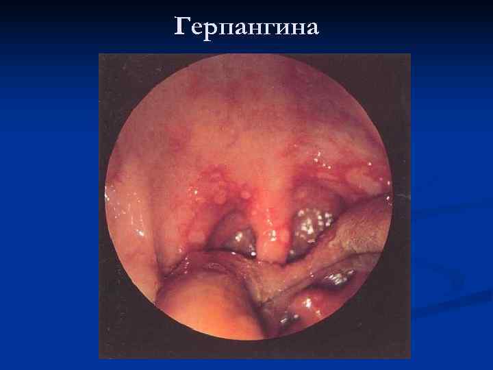 Герпангина 