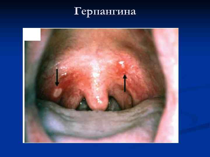 Герпангина 