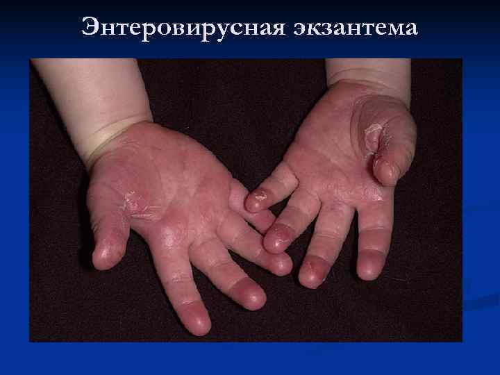 Энтеровирусная экзантема 