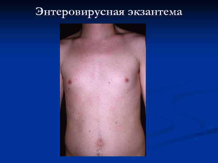 Энтеровирусная экзантема 