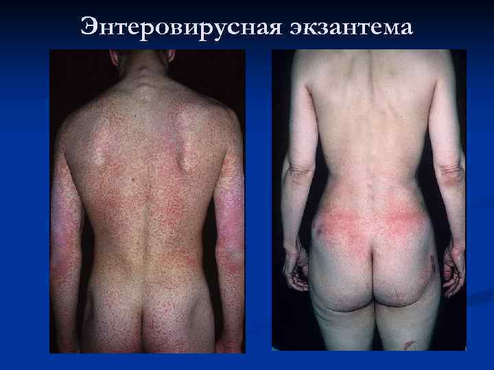 Энтеровирусная экзантема 