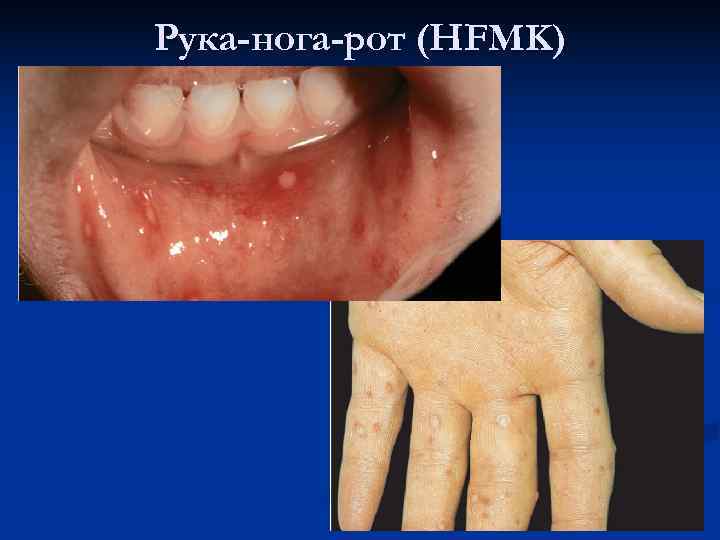 Рука-нога-рот (HFMK) 