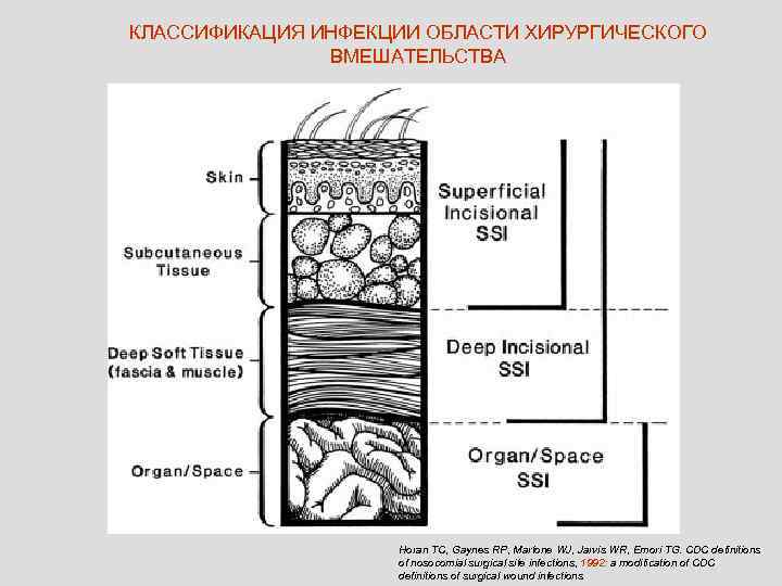 КЛАССИФИКАЦИЯ ИНФЕКЦИИ ОБЛАСТИ ХИРУРГИЧЕСКОГО    ВМЕШАТЕЛЬСТВА     Horan TC,