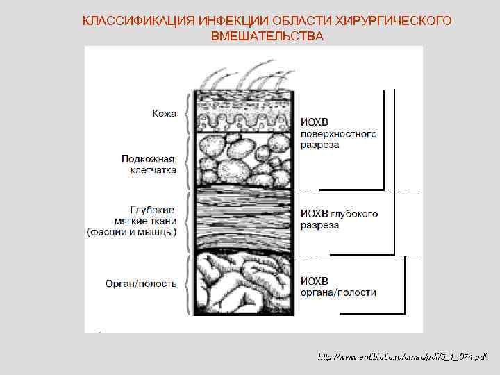 КЛАССИФИКАЦИЯ ИНФЕКЦИИ ОБЛАСТИ ХИРУРГИЧЕСКОГО    ВМЕШАТЕЛЬСТВА      