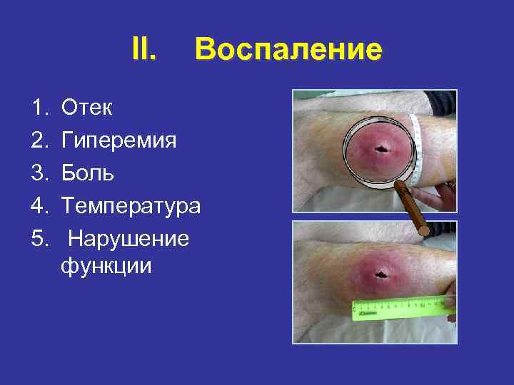 II. Воспаление 1. Отек 2. Гиперемия 3. II. Воспаление 1. Отек 2. Гиперемия 3.