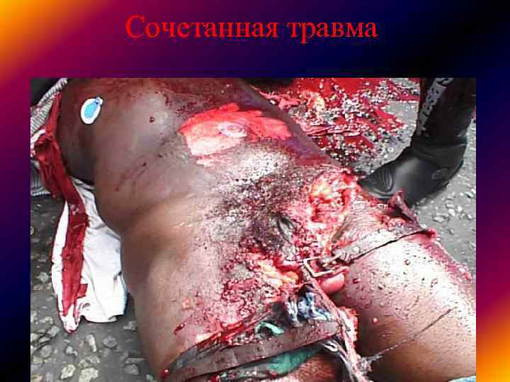 Сочетанная травма Сочетанная травма