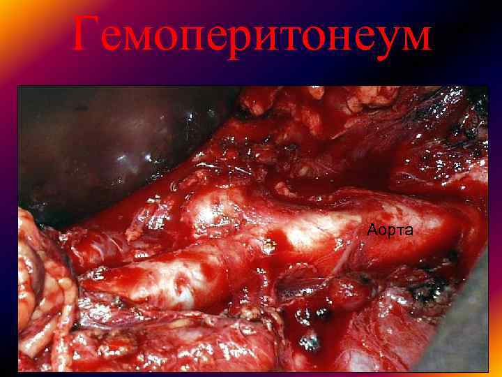 Гемоперитонеум Аорта Гемоперитонеум Аорта