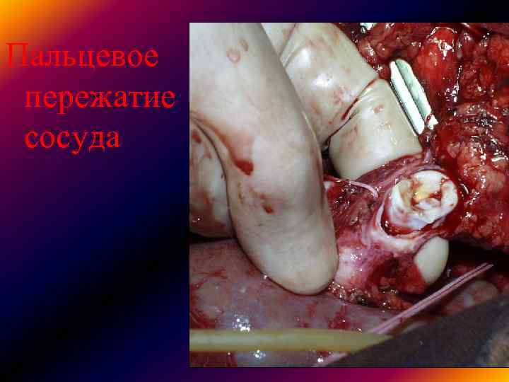 Пальцевое пережатие сосуда Пальцевое пережатие сосуда