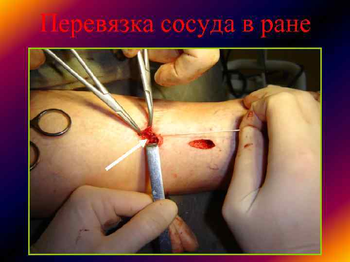 Перевязка сосуда в ране Перевязка сосуда в ране