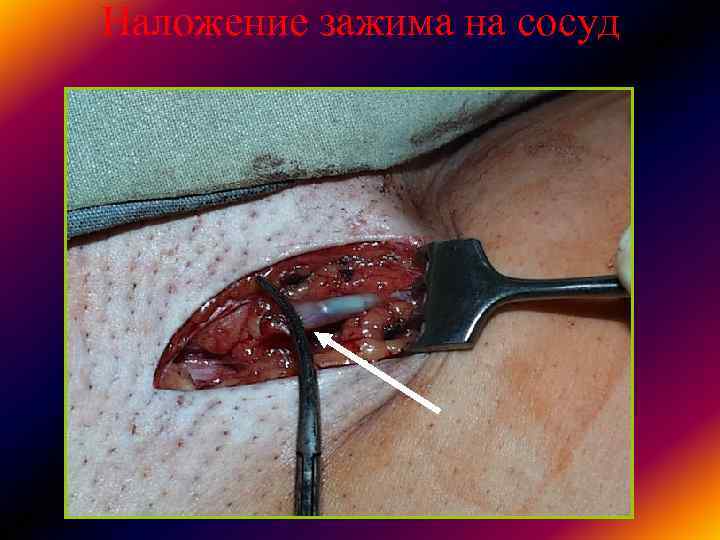 Наложение зажима на сосуд Наложение зажима на сосуд