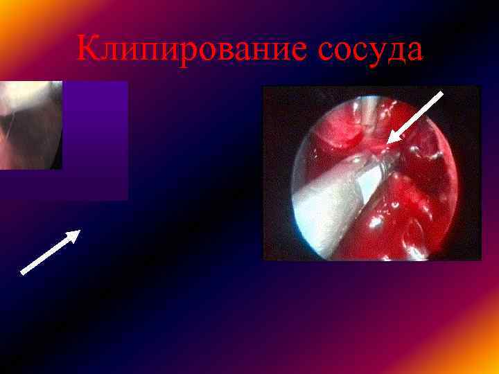 Клипирование сосуда Клипирование сосуда