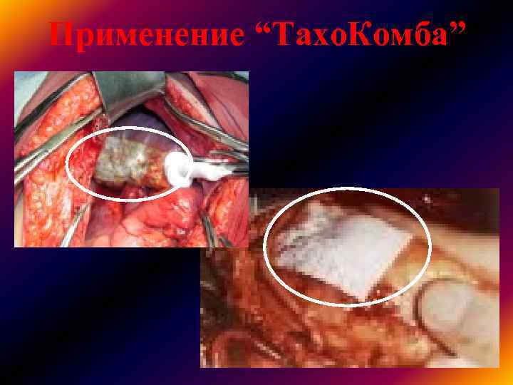 Применение “Тахо. Комба” Применение “Тахо. Комба”