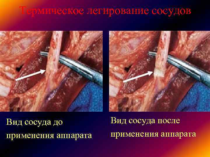 Термическое легирование сосудов Вид сосуда до Вид сосуда после применения аппарата Термическое легирование сосудов Вид сосуда до Вид сосуда после применения аппарата