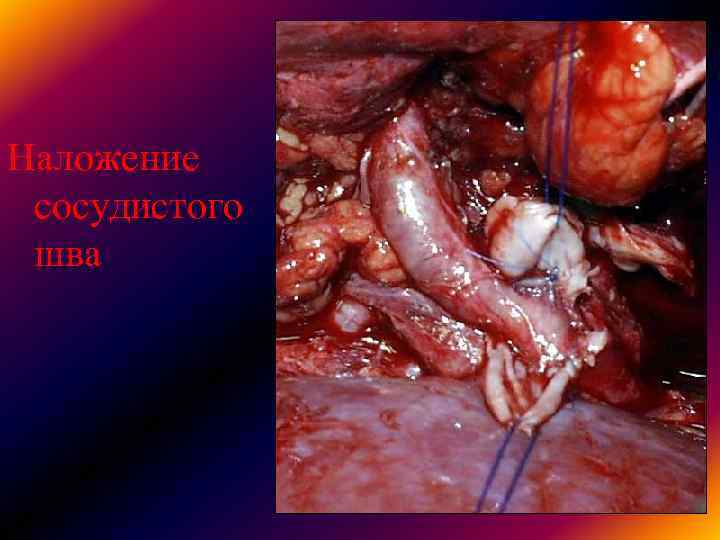 Наложение сосудистого шва Наложение сосудистого шва