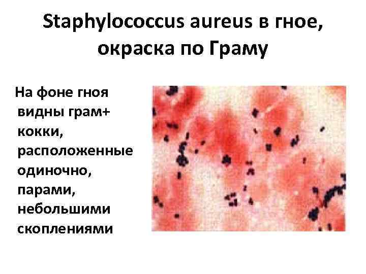   Staphylococcus aureus в гное,   окраска по Граму На фоне гноя