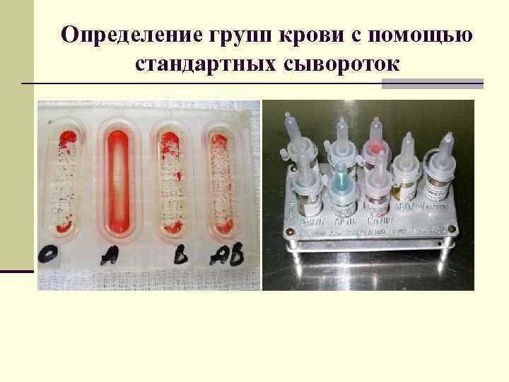 Определение групп крови с помощью стандартных сывороток 