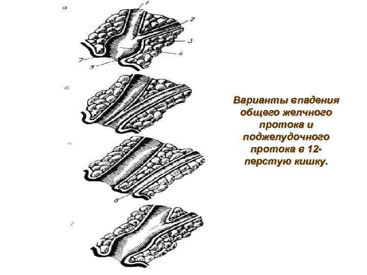 Варианты впадения общего желчного протока и поджелудочного  протока в 12 -  перстую