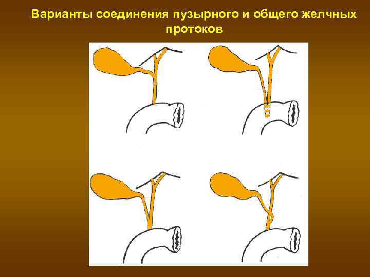 Варианты соединения пузырного и общего желчных    протоков 
