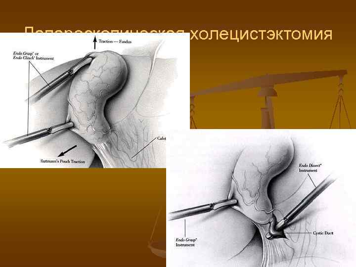 Лапароскопическая холецистэктомия 